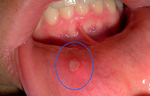 4 cách để chữa trị nhiệt miệng
