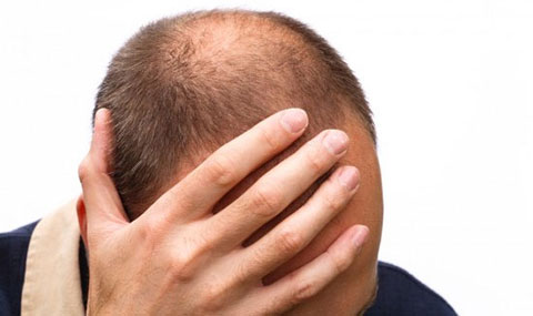 Bí ẩn về DHT và chứng hói đầu ở con người