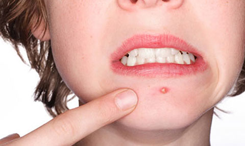 Mách bạn cách chữa mụn bọc hiệu quả tại nhà