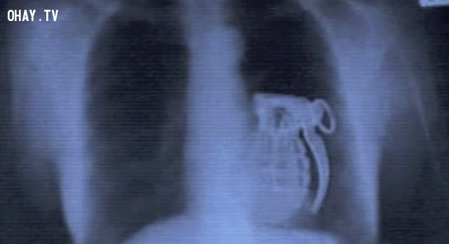 15 đồ vật đáng sợ nhất từng được tìm thấy trong các tấm phim X-quang