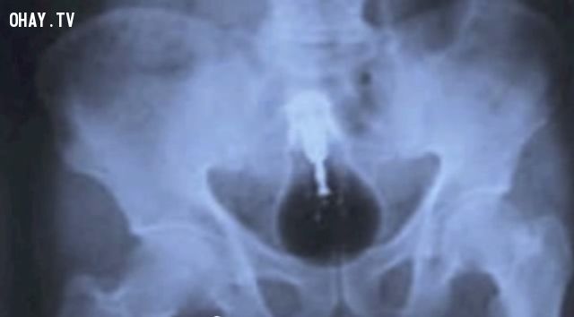 15 đồ vật đáng sợ nhất từng được tìm thấy trong các tấm phim X-quang