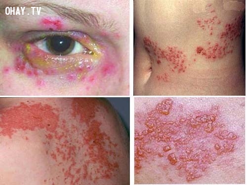 Sốt Rickettsia Sốt Rickettsia,dịch bệnh