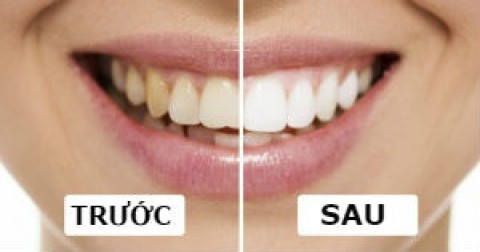 Mách bạn 9 mẹo đơn giản để có nụ cười thương hiệu Hollywood
