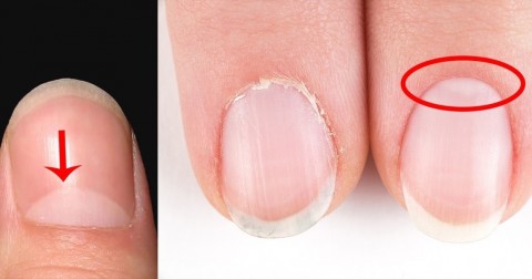 Liềm móng tay nói gì về sức khỏe của bạn?