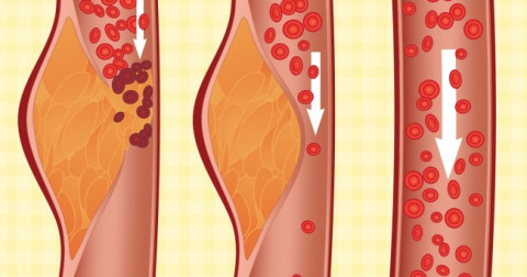 Chế độ ăn kiêng DASH Diet là gì và tại sao nó được cho là chế độ ăn kiêng tốt nhất?