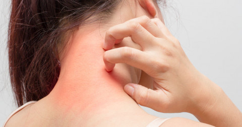 Dị ứng và những sai lầm hay mắc phải