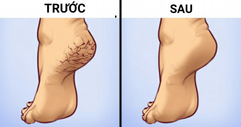 Mẹo trị vết chai sần trên chân hiệu quả