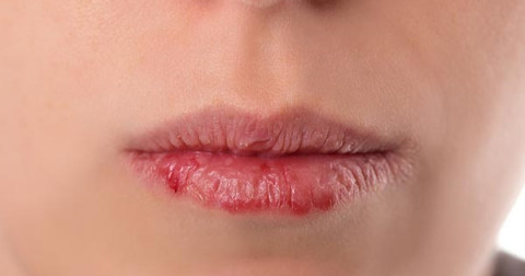 Môi nứt nẻ tiết lộ gì về sức khỏe?